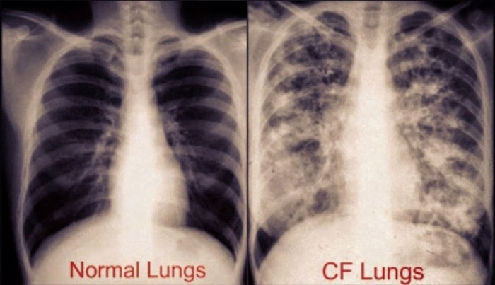 Carrier cystic fibrosis fibrose disease