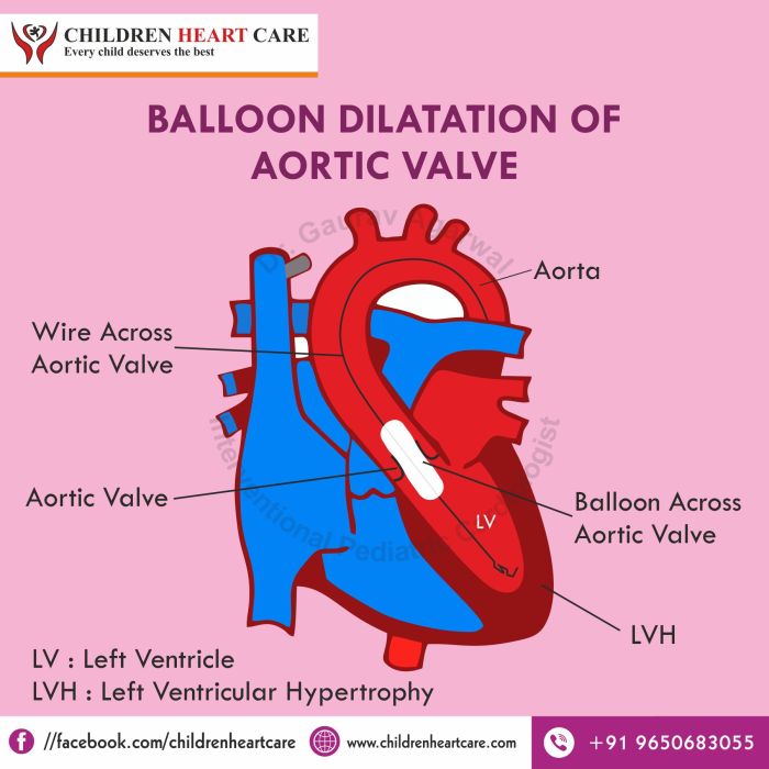 Balloon aortic valvuloplasty cpt code