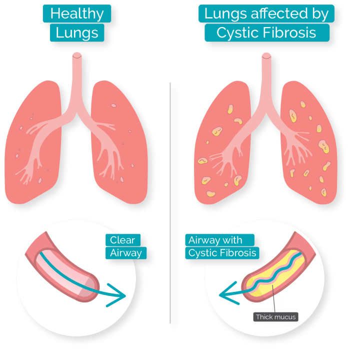 Cystic fibrosis