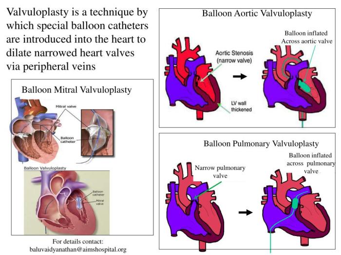 Balloon aortic valvuloplasty cpt code