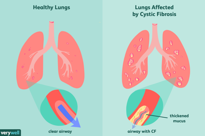 Do i have cystic fibrosis quiz